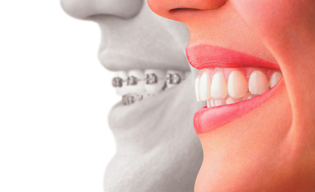 Invisalign Ortodoncia