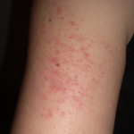 Keratosis_pilaris_arm