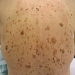 Seborrheic_keratosis_on_human_back