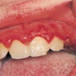 gingivoestomatitis-herpetica