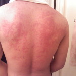 urticaria