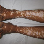 Vitiligo