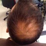 Alopecia