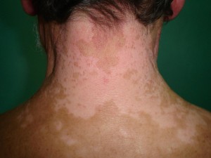 vitiligo_neck_0