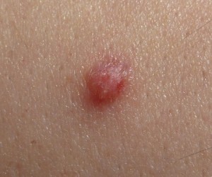 Papilloma_2009_G2